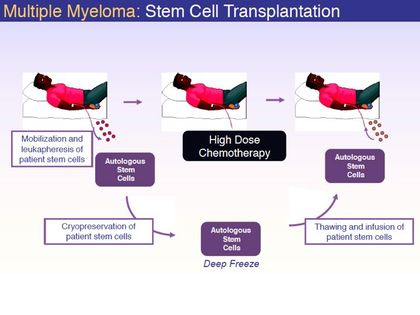 autologous stem cell transplant for multiple myeloma